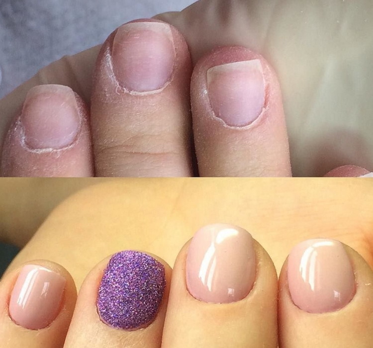 маникюр на обгрызанные ногти до и после